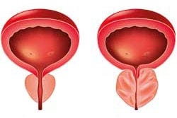 normale und vergrößerte Prostata normale und vergrößerte Prostata